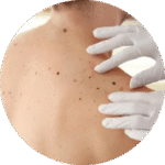 Lesión de melanoma en la piel con forma irregular, bordes mal definidos y múltiples tonalidades, indicativos de cáncer de piel.